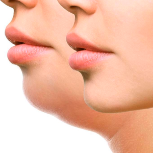 chin contouring with hyaluronic acid