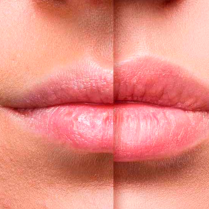 lip enhancement with hyaluronic acid